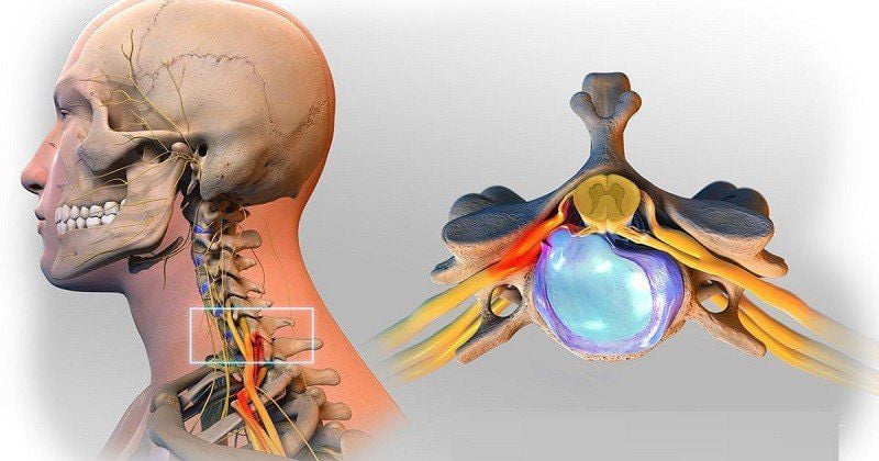 tê tay thoái hoá cổ